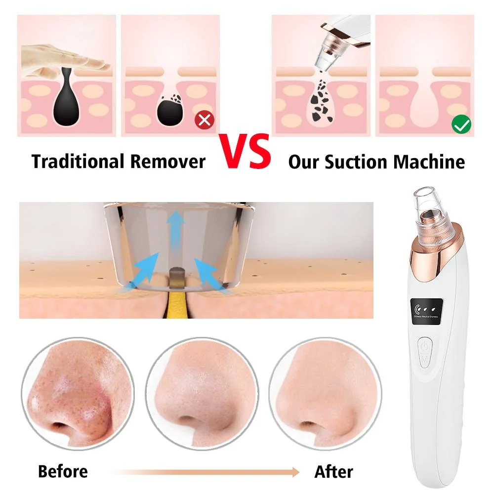 5-in-1 Acne & Blackhead Remover
